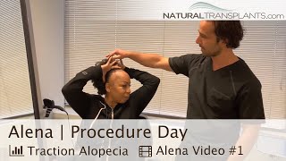 African American Female Traction  Edges Hair Transplant  Dr Kevin Blumenthal Alena [upl. by Charlena]