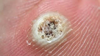 5 Remedies  How To Get Rid Of Verruca  Remove Warts [upl. by Aleuqahs]