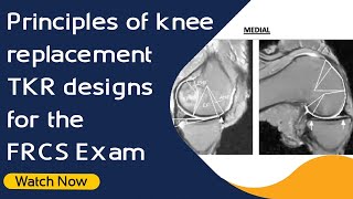 Principles of knee replacement TKR designs for the FRCS Exam  Orthopaedic Academy [upl. by Mattson]