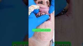 Descubre Como Los Implantes Dentales se Pueden Reutilizar implantesdentales saluddental shorts [upl. by Valora]