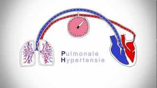 Pulmonale Hypertensie wat is dat [upl. by Thirzi]