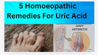 Homoeopathic medicine for uric acidTreat uric acid Without side effects [upl. by Notsej580]