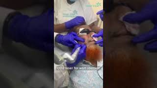 CO2 Laser  Wart Removal  Dhaka Dermatology Institute  LaserTreat [upl. by Iruj]