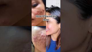 Pimples na hege clear madodu Kannada Skincare [upl. by Grayce502]