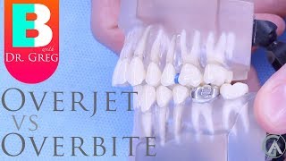 BRACES EXPLAINED Overbite vs Overjet [upl. by Kaine]