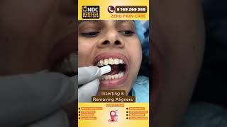 Aligner Tips  Inserting And Removing Aligners safely  Best Dental Hospital In Hyderabad  NDC [upl. by Ruprecht420]