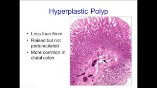 Hyperplastic Polyps Not Always What They Seem [upl. by Feil585]