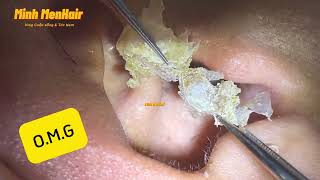 Dry earwax deep in the ear how does it feel 耳掃除 Asmrlấy ráy tai  Minh MenHair [upl. by Niuqram113]