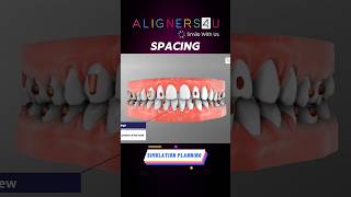 Smile Makeover with Clear Aligners In Hyderabad  Invisible Aligners Braces  Correction of Teeth [upl. by Gitt]