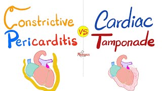 Constrictive Pericarditis vs Cardiac Tamponade  Cardiology Series [upl. by Jeanne373]