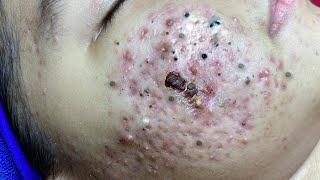 Big Cystic Acne Blackheads Extraction Blackheads amp Milia Whiteheads Removal Pimple Popping  65587 [upl. by Osborne93]