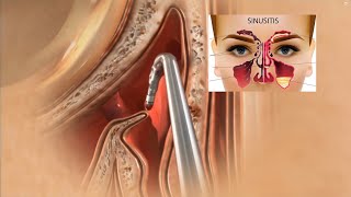 Sinus Surgery 3D Animation  Sinusitis Treatment  Sinus Operation [upl. by Reteip164]