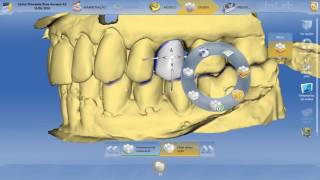 CadCam Cerec Sirona 25 [upl. by Haugen]