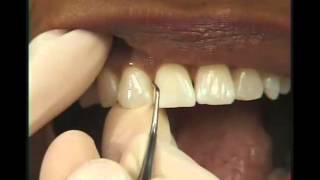 Periodoncia  Raspado [upl. by Aekerly958]