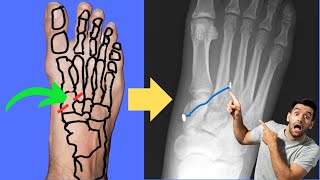 Lisfranc Injury Can it be fixed with an ANKLE TIGHTROPE [upl. by Mcleroy]