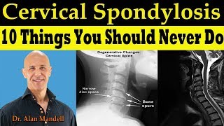 CERVICAL SPONDYLOSIS 10 Things You Should Never Do  Dr Alan Mandell DC [upl. by Aksel]