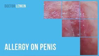 😟 Allergy on penis [upl. by Yatnahs]