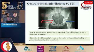 Session 43 Femoral neck lengthening for coxa brevia  Mohamed El Sabaa 232023 [upl. by Cummine]