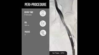 Venous Thrombosis of Right Lower Extremity  Symphony™ Thrombectomy System [upl. by Lunt]