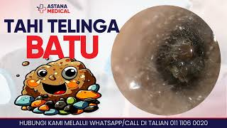 Tahi Telinga Batu Ear Wax Removal at Klinik Astana Medical Ampang 24 Jam [upl. by Xavier]