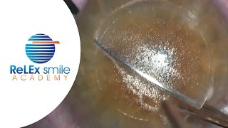 ReLEx smile Academy Dissection of lenticule Step 10 amp 11 [upl. by Lebasi]