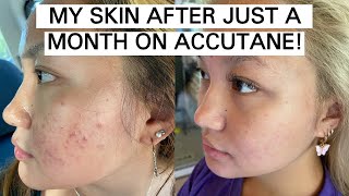 my accutane journey month 1 [upl. by Elak515]