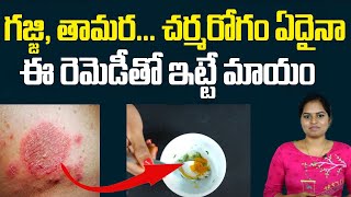 ఈ చిట్కాతో గజ్జి తామర మాయం  Best Home Remedies for Skin Allergies  Remedies For Fungal Infections [upl. by Keynes]