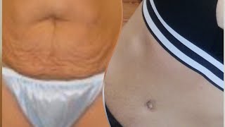 Avant abdominoplastie et après abdominoplastie [upl. by Milty85]