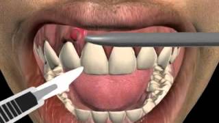 How to treat a tooth abscess [upl. by Anitsuj]