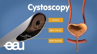 Cystoscopy overactive bladder [upl. by Asilim]