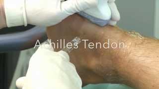 OSTENIL® Tendon injection 14 Achilles Tendon [upl. by Ehc752]