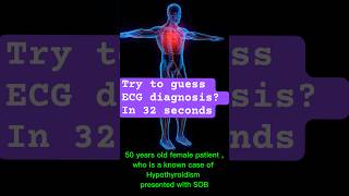 ecgdiagnosis hypothyroid hypothyroidism cardiology ecganalysis [upl. by Terencio]