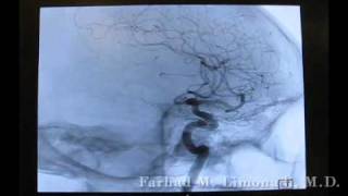 3D Cerebral Angiography [upl. by Iek]