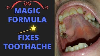 Relieve severe toothache with this magical formula GUARANTEED [upl. by Yenor49]