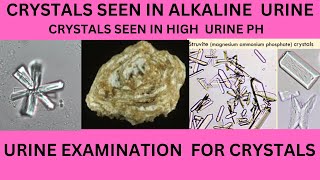 CRYSTALS IN ALKALINE URINECAUSES SYMPTOMS AND TREATMENT OF URINARY CRYSTALS URINE EXAMINATION [upl. by Llerdnad]