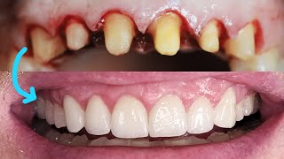 Front Tooth Crowns Before amp After Cosmetic Dentist Smile Makeover EMAX Preparation Remove Veneers [upl. by Syned]