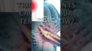 Are Trigger Points Causing Your Tennis Elbow [upl. by Horgan]