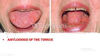 Amyloidosis Clinical course Symptoms and Signs Diagnosis and Prognosis of the disease [upl. by Islehc]