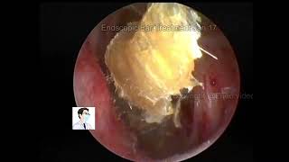 Ear wax removal CERUMEN Cleaning 20220117 [upl. by Kiran]