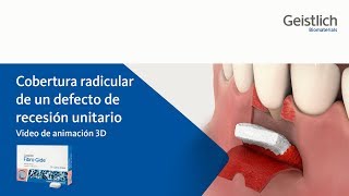 Geistlich FibroGide®  Recesión unitario [upl. by Diet]