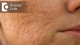 How to remove Acne scars by natural remedies  Dr Chetali Samant [upl. by Yattirb]