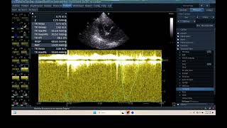 IQ 306 HEMODYNAMIC ECHOPAC ANALYSIS ECHOCARDIOGRAPHY HEPATOMA PTE [upl. by Acherman]