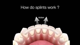 How Do Dental Splints Work [upl. by Riana459]