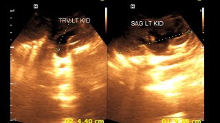 Bilateral hydro nephrosis  Bilateral dilated ureter  Renal Ultrasonography [upl. by Marya24]