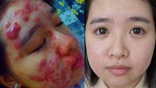 AcneSkin Update  25 Years Post Treatment [upl. by Yditsahc]