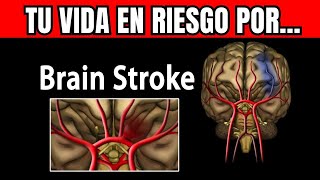 DERRAME CEREBRAL Tipos causas patología síntomas tratamientos y prevención [upl. by Eusebio556]