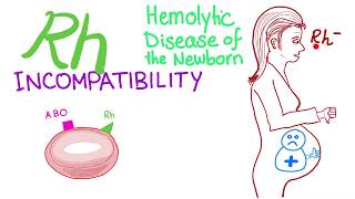 Rh incompatibility and Hemolytic disease of the newborn HDN [upl. by Ecinerev]