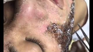 Chemical Peel Result After Treatment  Face Peel for Acne Part 1 22 August 2019 [upl. by Anelra]