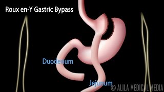 Roux enY Gastric Bypass with Introduction on Body Mass Index Animation [upl. by Paresh]