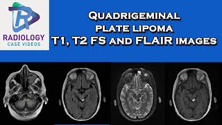 Quadrigeminal plate lipoma T1 T2 FS and FLAIR images [upl. by Dnar]